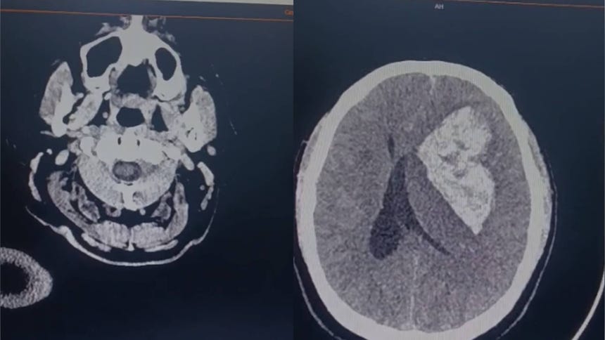 Adulto que sufrió derrame cerebral fue trasladado al Instituto Nacional de Ciencias Neurológicas